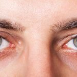 Allergic conjunctivitis treatment in adults