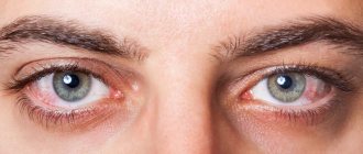 Allergic conjunctivitis treatment in adults