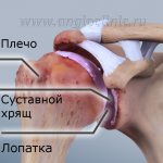Arthrosis of the shoulder joint