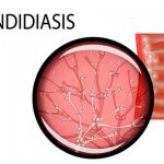 Bacteria for oral candidiasis in pictures
