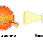 Myopia (myopia)