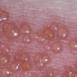 bullous form of herpes zoster
