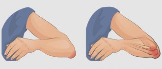 elbow bursitis