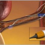 Denervation of the renal arteries