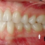 Gingival groove
