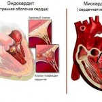 Endocarditis and myocarditis