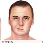 Erythema/facial paralysis/swollen knee
