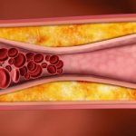 If a large amount of cholesterol enters the blood, its excess remains in the bile