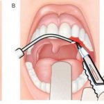 stages of opening a paratonsillar abscess