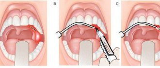 stages of opening a paratonsillar abscess