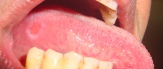 Photo of a patient with aphthous glossitis