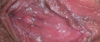Photos of thrush symptoms in women
