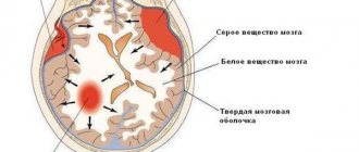 Гематомы головного мозга