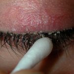 eyelid hygiene blepharitis