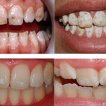 Enamel hypoplasia and wedge-shaped tooth defect