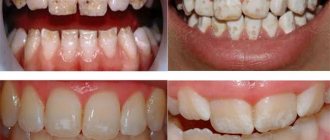 Гипоплазия эмали и клиновидный дефект зубов