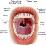 Ulcers on the tonsils without fever or pain. Purulent tonsils without fever: diagnoses, treatment 