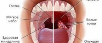 Ulcers on the tonsils without fever or pain. Purulent tonsils without fever: diagnoses, treatment 