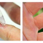 Chemical methods for treating warts