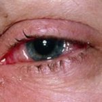 Инфекция глаз