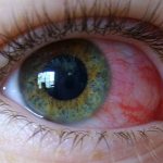 How to treat hemorrhage in the eye