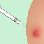 What does a lump look like after an injection?