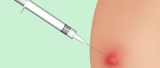 What does a lump look like after an injection?