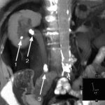 Kidney stones on CT scan