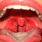 Catarrhal sore throat photo