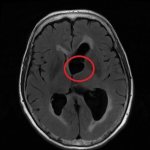Cyst on MRI of the brain