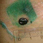A tick that the patient mistook for papilloma.