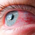 Conjunctivitis is an inflammatory lesion of the conjunctiva