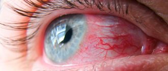 Conjunctivitis is an inflammatory lesion of the conjunctiva