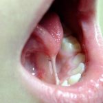 Short frenulum of the tongue in a child