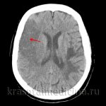 КТ головного мозга. Обширный ишемический инсульт в височной и теменной доле справа