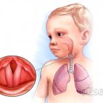 Laryngotracheitis in children