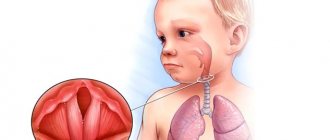 Laryngotracheitis in children