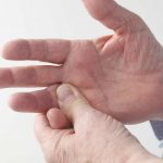 Treatment of eczema on hands