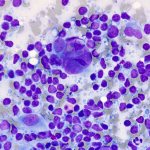 Lymphocytosis in adults
