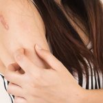 Ringworm: what it looks like and how to treat it