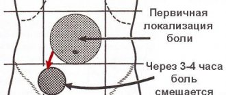 Локализация болей при воспалении аппендикса