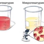 Макро- и микрогематурия