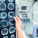 Meningioma of the brain: life prognosis, reviews of treatment