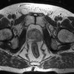 MRI (T2-weighted images) picture of the lesion in the left lobe of the prostate gland