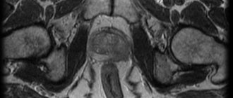 МРТ (Т2-взвешенные изображения) картина поражения левой доли предстательной железы