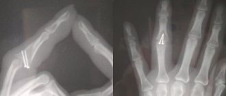 Неправильно сросшийся перелом пальца руки
