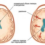 Normal and hydrocephalus of the brain