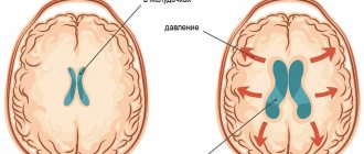 Normal and hydrocephalus of the brain