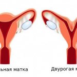 Normal and bicornuate uterus