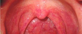 Normal condition of tonsils